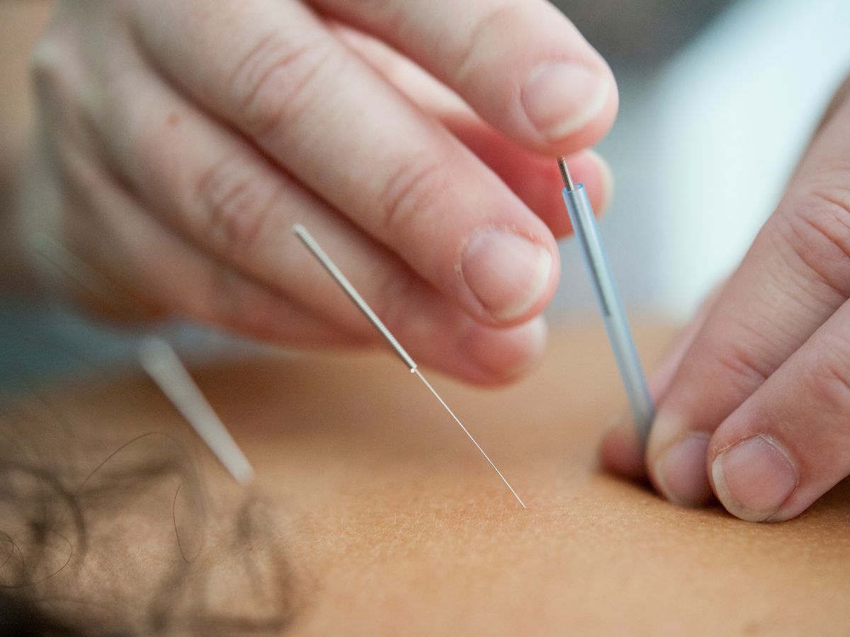 Acupuncture et CBD  quel intérêt de les combiner